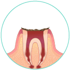 残念ですが抜歯に
