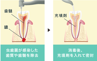虫歯菌が感染した歯質や歯髄を除去・消毒後、充填剤を入れて密封