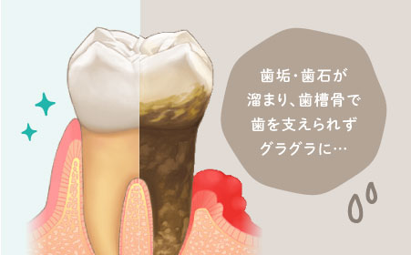 歯垢・歯石が溜まり、歯槽骨で歯を支えられずグラグラに